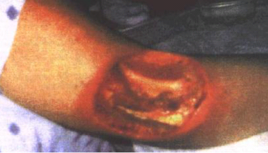 Deep ulceration with exposure of the humerus following medical x-ray procedure
