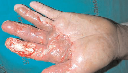 Left hand 8 weeks after handling cobalt-60 teletherapy source