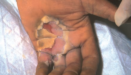Moist desquamation after handling industrial radiography source