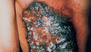 Necrosis of epidermis following exposure to industrial radiography source