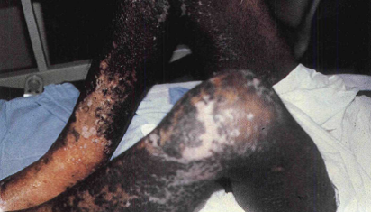 Radiation burns after accidental exposure in industrial irradiation facility